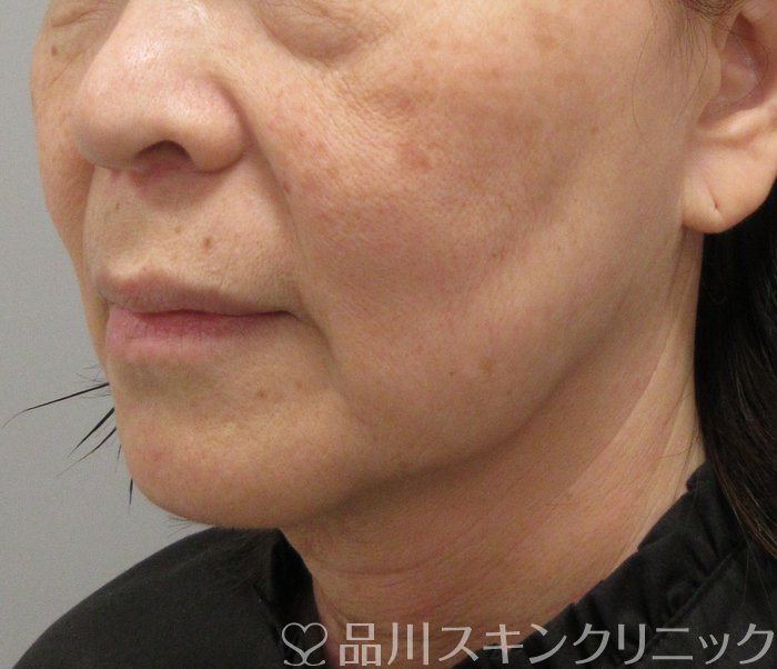 症例NO.74802のBEFORE写真