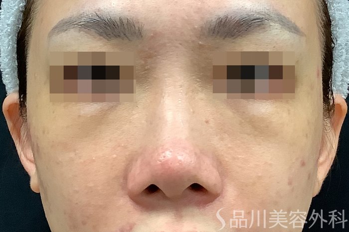 症例NO.71638のBEFORE写真