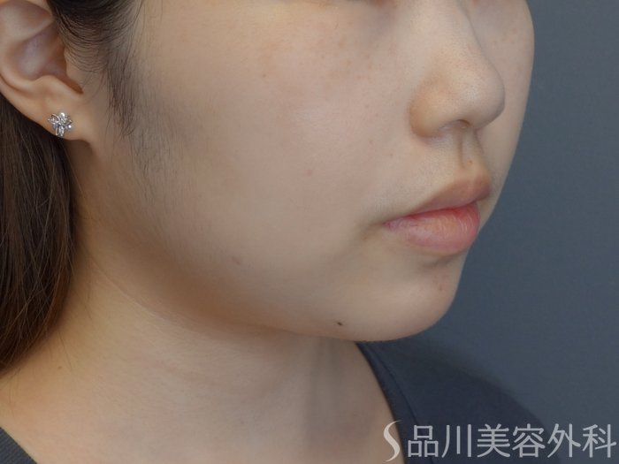 症例NO.73387のAFTER写真