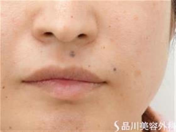 症例NO.35308のBEFORE写真