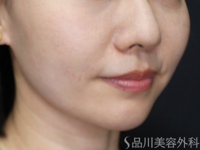 症例NO.71937のAFTER写真