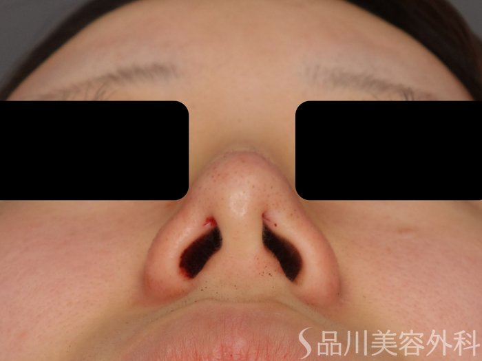 症例NO.73734のAFTER写真