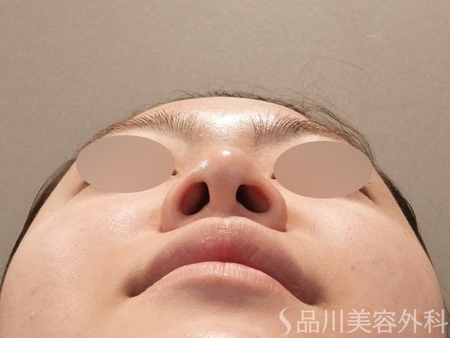 症例NO.75108のBEFORE写真