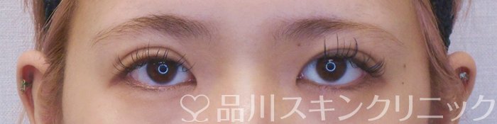 症例NO.75163のAFTER写真