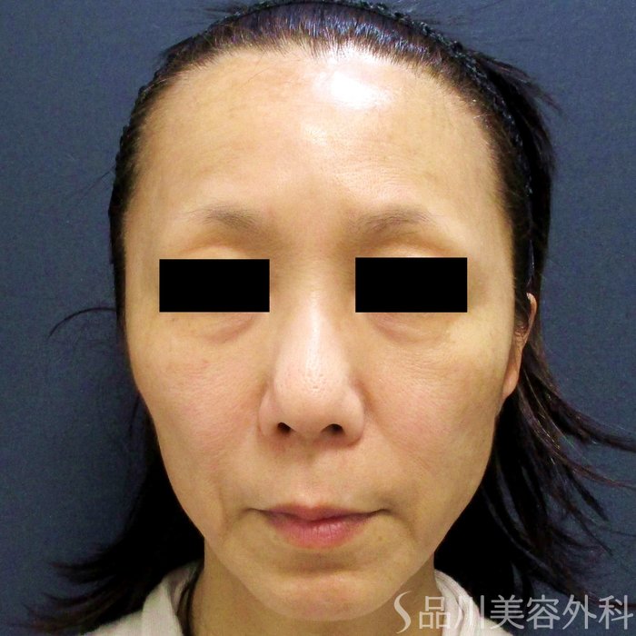 症例NO.65536のBEFORE写真