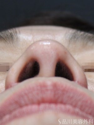 症例NO.69597のAFTER写真