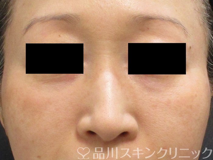 症例NO.64932のAFTER写真
