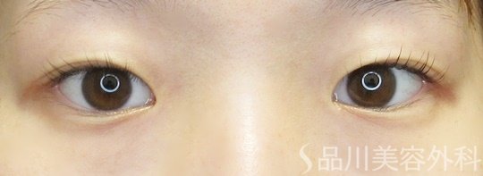 症例NO.65714のBEFORE写真