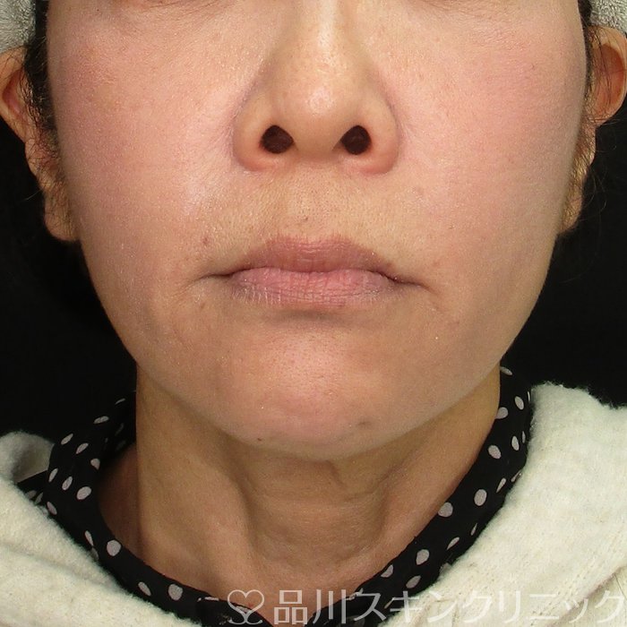 症例NO.69673のBEFORE写真