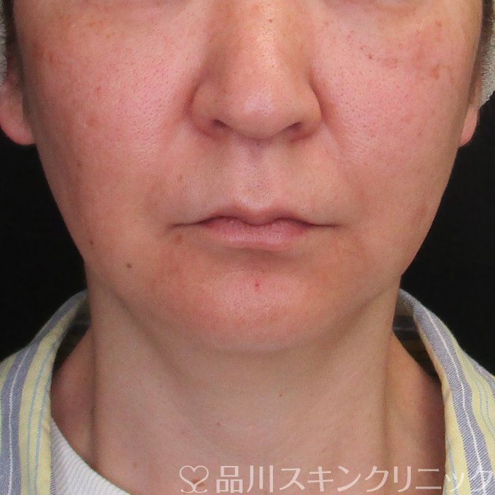 症例NO.73873のBEFORE写真