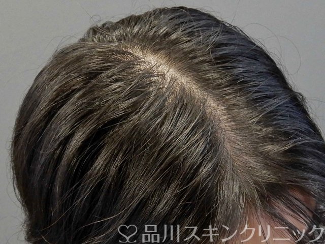 症例NO.69315のBEFORE写真