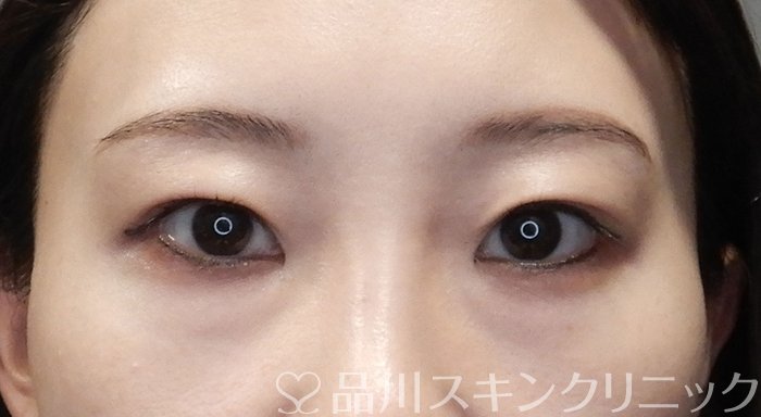 症例NO.72190のBEFORE写真