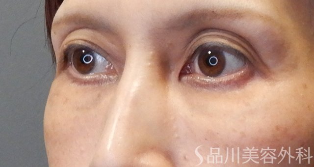 症例NO.67975のAFTER写真