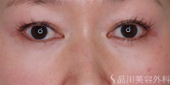 症例NO.49500のAFTER写真