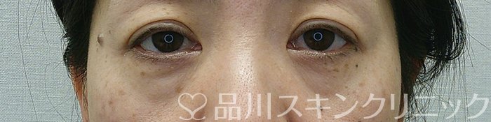 症例NO.70722のBEFORE写真