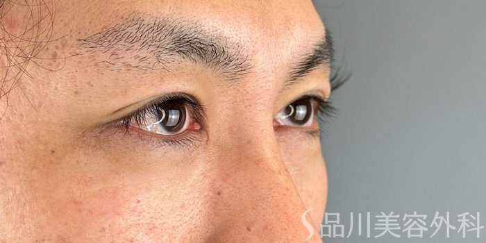 症例NO.70737のBEFORE写真