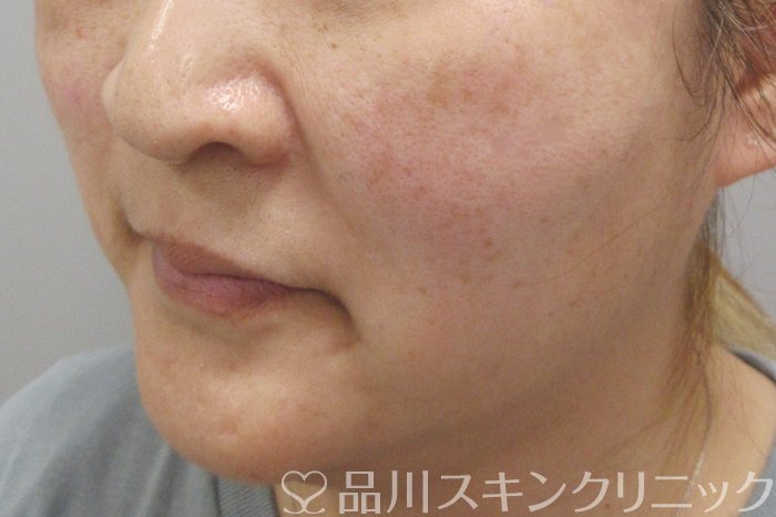 症例NO.70581のAFTER写真