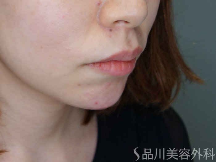 症例NO.70927のAFTER写真