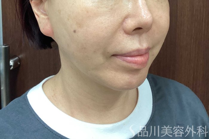 症例NO.71291のAFTER写真