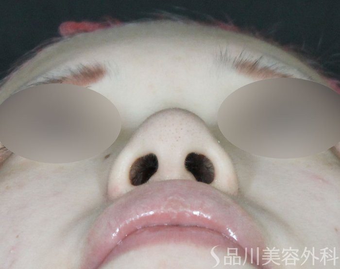 症例NO.72133のBEFORE写真