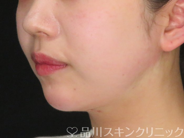 症例NO.65336のAFTER写真