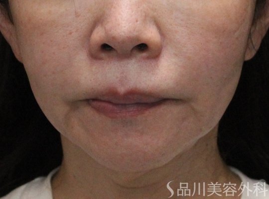 症例NO.75140のBEFORE写真