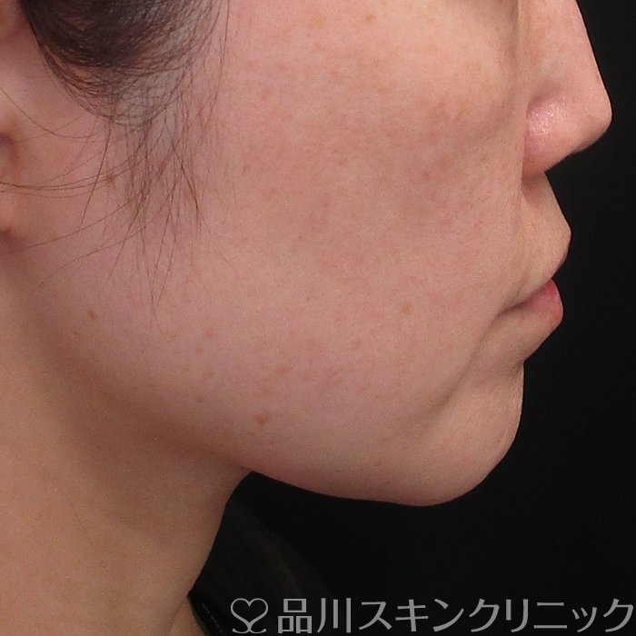 症例NO.73375のBEFORE写真