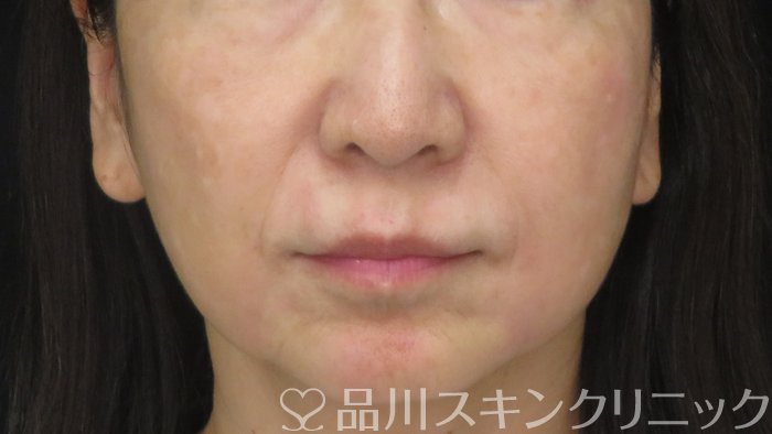 症例NO.72014のAFTER写真