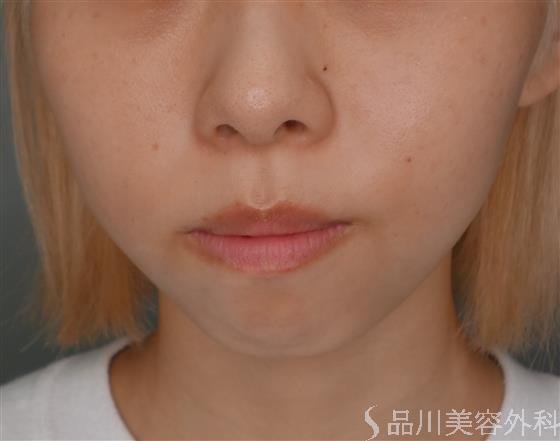 症例NO.52575のBEFORE写真