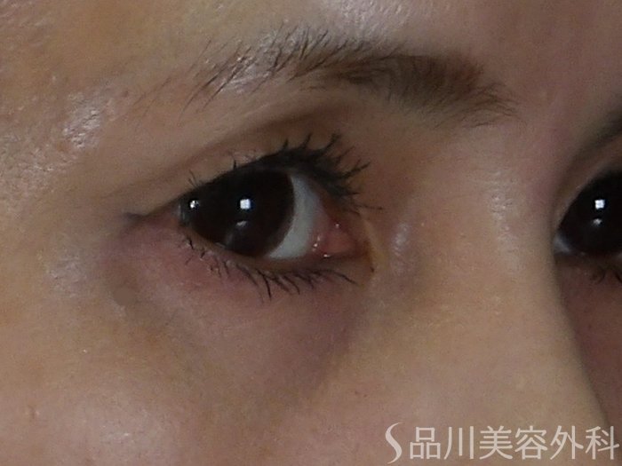 症例NO.70690のBEFORE写真