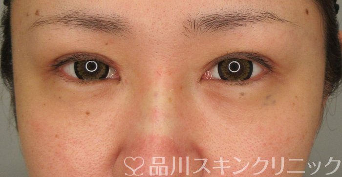 症例NO.73040のAFTER写真