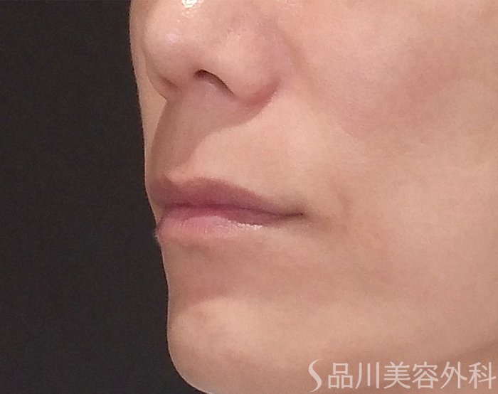 症例NO.70497のBEFORE写真
