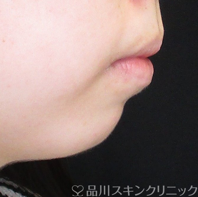 症例NO.62217のBEFORE写真