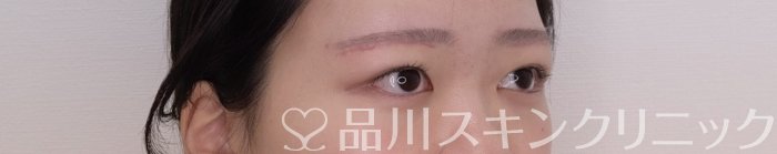 症例NO.69372のAFTER写真