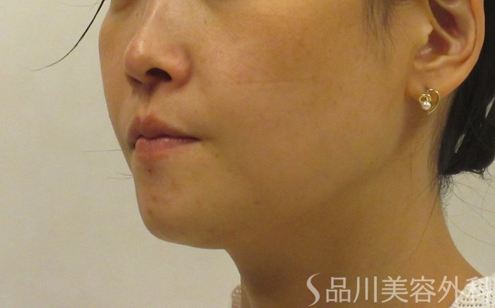 症例NO.71876のBEFORE写真