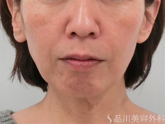 症例NO.26321のBEFORE写真