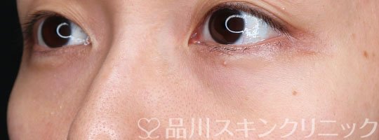 症例NO.63474のBEFORE写真
