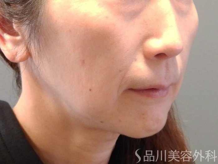 症例NO.65645のBEFORE写真