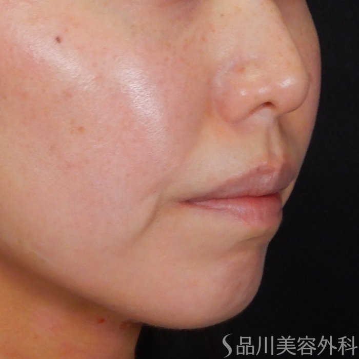 症例NO.67722のBEFORE写真