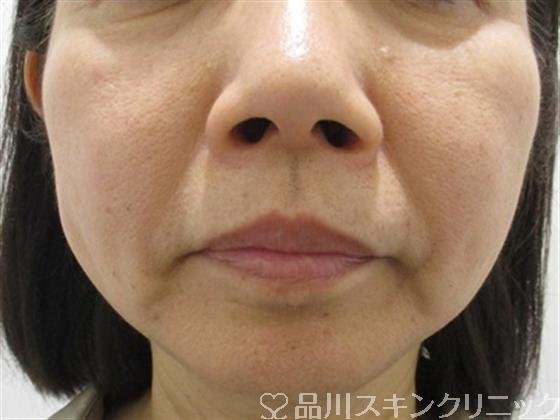 症例NO.34176のAFTER写真