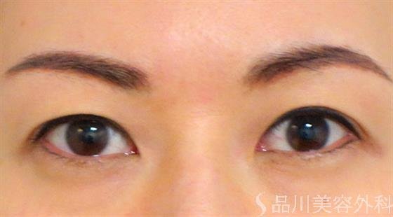 症例NO.27001のBEFORE写真