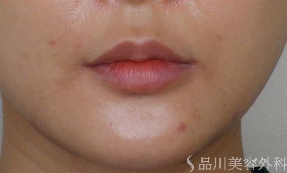 症例NO.48480のAFTER写真