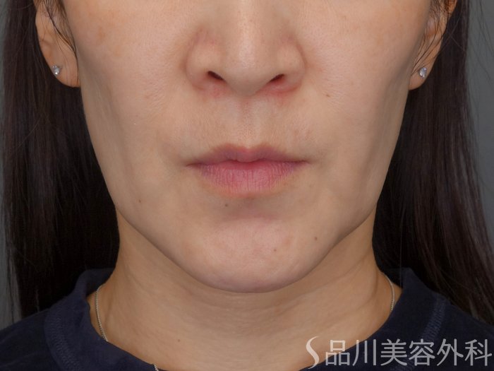 症例NO.72696のBEFORE写真