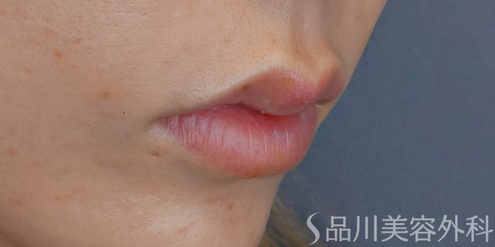 症例NO.72195のBEFORE写真