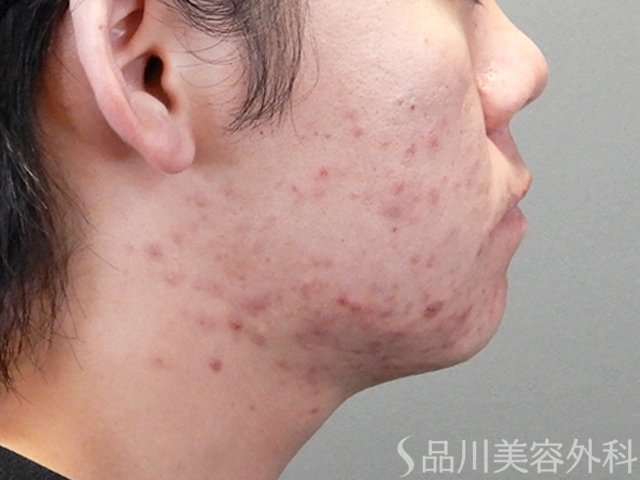 症例NO.69395のBEFORE写真