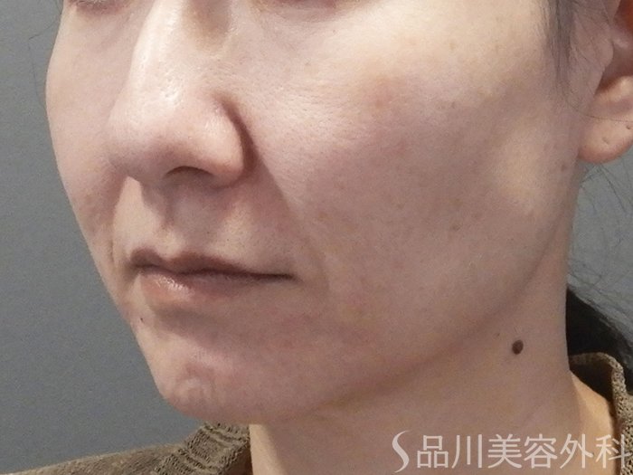 症例NO.72103のBEFORE写真