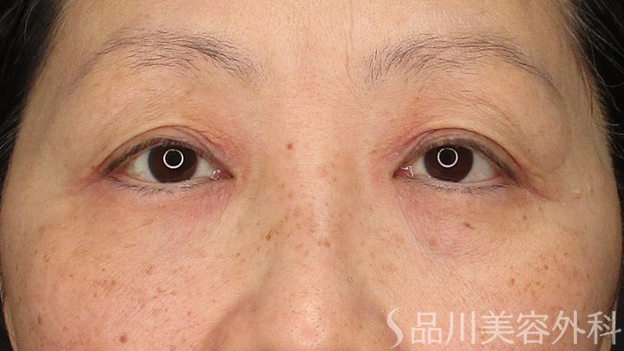 症例NO.71807のBEFORE写真