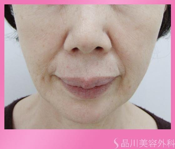 症例NO.860のBEFORE写真