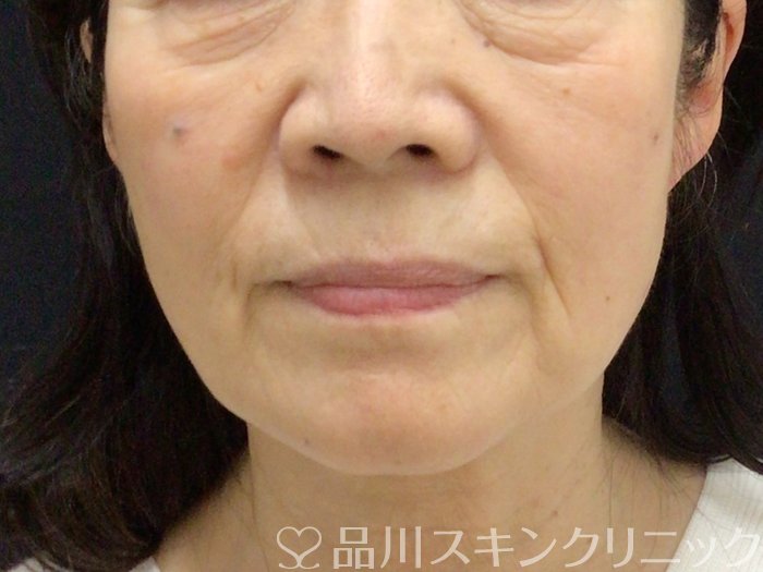 症例NO.69638のBEFORE写真