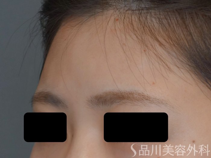 症例NO.74601のAFTER写真